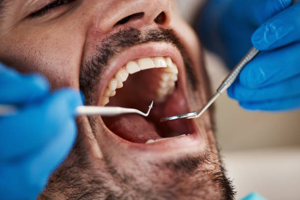 Best Emergency Tooth Extraction in Columbus, MS